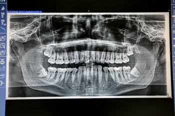 Панорамный ортопантомограф позволяет сделать «круговой» снимок всей зубо-челюстной системы
